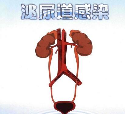 泌尿生殖感染